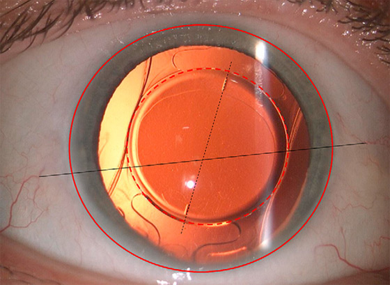 An image of a retro-illuminated toric intraocular lens (TIOL)