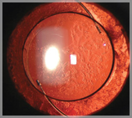 Intraocular Lens (IOL) Performance Studies